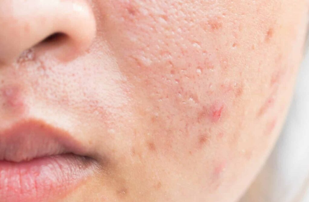 4 How to Whiten Acne Scars on the Face Quickly and Easily